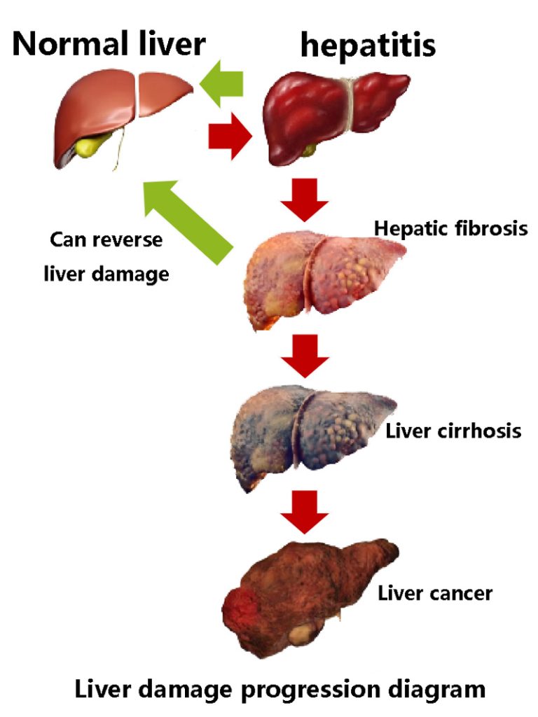 Liver damage progression diagram