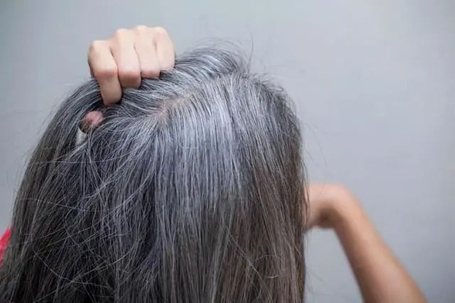 Why can NMN solve the problem of white hair and hair loss